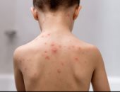 تعليم المنوفية: فحص طبى لجميع طلاب مدرسة بالباجور عقب إصابة 24 بالجدرى المائى