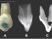 حشو أسنان أطفال المايا دليل على البلوغ.. دراسة تكشف