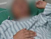 أكل ثعبان نىء.. إنقاذ صينى بإزالة دودة حية طولها 18 سم من دماغه.. صور