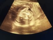 تحدث مرة واحدة بين كل 500 ألف.. جنينان فى بطن رضيعة هندية عمرها شهر واحد