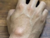 تظهر حول المفاصل.. أطباء يحذرون من محاولة تفريغ أكياس العقد العصبية