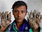 متلازمة الرجل الشجرة.. مرض نادر يحول جلد المصابين ليشبه أغصان الشجر