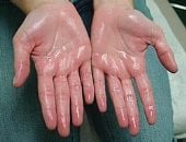 تعرق اليدين والقدمين.. متى يتحول الأمر إلى حالة طبية تحتاج علاجا؟
