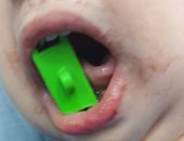 لأول مرة بمستشفى بنها.. عملية جراحية 4 ساعات لطفلة عامين تعانى حالة تيبس بالفكين