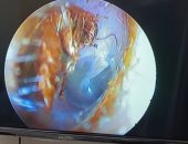 استخراج صرصور من أذن شاب بالقليوبية.. وطبيب يقدم روشتة للتعامل مع تلك الحالات