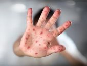 الصحة تطمئن المواطنين: فيروس HFMD عدوى خفيفة ولا تدعو للقلق