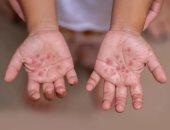 التعليم تكشف تفاصيل ظهور فيروس HFMD بين طلاب إحدى المدارس: رصد 4 حالات ظهرت عليهم أعراض حبوب باليدين واتخاذ الإجراءات الوقائية اللازمة.. ووزارة الصحة: إصابات الفيروس بسيطة ولا تشكل خطرا ولا داعى لإغلاق المدارس