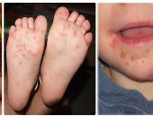 كيف يختلف فيروس اليد والقدم عن جديرى الماء والهربس.. علامات توضح الفرق فى الشكل والأعراض المتشابهة.. أهم أسباب انتقال العدوى وطرق الوقاية.. الترطيب والراحة ضرورة.. وهل يصيب HFMD الكبار.. صور 