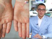 وزارة الصحة: فيروس HFMD لا يشكل خطرا ولا داعى لإغلاق المدارس.. فيديو
