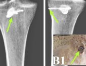 فحص رفات رجل جريح مغروز فى ساقه رأس سهم عمره 2000 عام فى إيران 