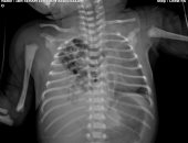 جراحة نادرة تنقذ حياة طفل من فتق بالحجاب الحاجز بمستشفى زاوية الناعورة