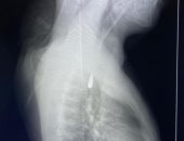 جامعة الإسكندرية: المريض الفلسطيني فى مرحلة التعافى حاليا