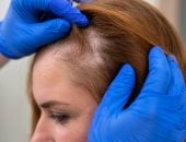 نقص الحديد وفيتامين ب12 أبرزها.. حالات صحية يكشف عنها شعرك