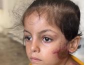 سفر الطفلة جود ماضي للعلاج خارج غزة بعد نشر "اليوم السابع" قصة إصابتها