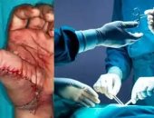 أطباء ينجحون في إعادة بناء إبهام شاب باستخدام إصبع من ساقه المبتورة