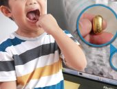 إنقاذ طفل صينى ابتلع كتلة ذهبية أثناء تمرين اللسان