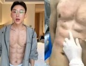 مؤثر صينى ينفق 560 ألف دولار للحصول على عضلات بطن وهمية بحقن الهيالورونيك