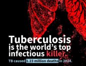 الصحة العالمية: 10.7 مليون بالعالم أصيبوا بالسل مع 1.23 مليون وفاة فى 2024