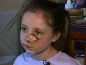 طفلة تتعرض لهجوم مروّع من كلب فى ألاباما.. جروح خطيرة وصدمة فى المجتمع المحلى