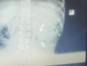 إنقاذ حياة طفل ابتلع مسمارًا بمجمع الشفاء الطبى فى بورسعيد.. صور