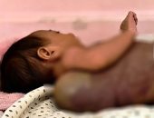 رضيعة على حافة الخطر.. حبيبة أبو رضوان تصارع كيسا دمويا وسط عجز طبي بغزة.. صور