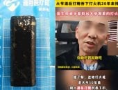 أطباء يكتشفون ولاعة فى معدة رجل صينى عاش بها 30 عاما