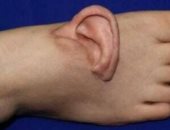 امرأة صينية تعيد تثبيت أذنها بعد 5 أشهر من زراعتها فى باطن قدمها