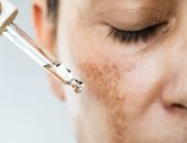 وصفات طبيعية سهلة للتخلص من البقع الداكنة الناتجة عن حب الشباب