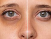 وصفات طبيعية للتخلص من الهالات السوداء