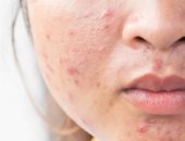 وصفات طبيعية للتخلص من ندبات حب الشباب.. من خل التفاح لعصير الليمون