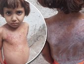 جودى حنون.. طفلة فلسطينية فقدت شقيقتيها وتعانى من مرض خطير يحتاج لزراعة نخاع