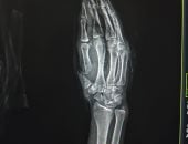 إنقاذ شاب من بتر كامل بإصبع الإبهام بمستشفى سوهاج الجامعي