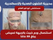 نحاح عمليتى استئصال ورم الخبيث بالجبهة بمستشفى أبو قير العام