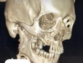 فريق طبى بمستشفى أجا ينجح في إعادة بناء وجه مريض عقب حادث دراجة نارية..صور