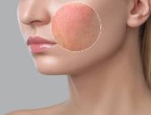 وصفات طبيعية لعلاج المسام المفتوحة.. أبرزها بياض البيض