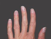 ماذا يكشف لون أظافرك عن صحتك ومتى يجب زيارة الطبيب