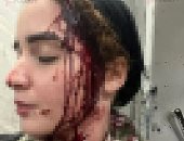 ضحية تشويه وجهها بالعجوزة: المتهم كان يمارس البلطجة ووجهت له تهمة استعراض القوة