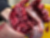 إنقاذ ذراع طفل بمستشفى طوارئ جامعة سوهاج بعد إصابة مروعة