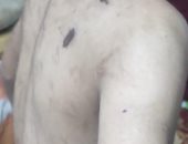 النيابة تباشر التحقيق مع زوجة الأب المتهمة بتعذيب نجل زوجها