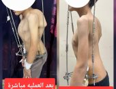 فريق طبى بمستشفى الزهراء الجامعى يجرى جراحة لتصحيح تشوه بالعمود الفقرى