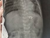 فريق جراحى بمستشفى ناصر التخصصى ينقذ رضيع عمره 14 يوماً من جسم غريب فى معدته