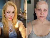 أطفالها لا يعرفونها دون الباروكة.. قصة أم فقدت فروة رأسها فى حادث عمل