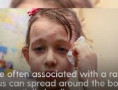كيف تنتشر الحصبة وما أعراضها وهل يمكن أن تسبب مضاعفات خطيرة؟