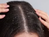 وصفات طبيعية لعلاج قشرة الرأس.. اتخلصى من الحكة والإحراج