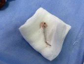 بعد وصلة هزار.. استئصال «مسمار» من صدر شاب فى البحيرة