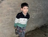 مشارط الأمل فى معهد ناصر.. فريق جراحى يعبر بقدم طفل باسوس للأمان النسبى.. عمل وصلات للأوردة والشرايين خلال 19 ساعة من التركيز.. وعم الطفل يشكر الأطباء ووزارة الصحة.. ويؤكد: ادعوا له الـ48 ساعة القادمة الأصعب