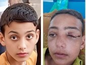 طفل غزة عبد الرحمن أبو جزر يفقد عينه وينتظر إجلاء عاجلا للعلاج خارج القطاع
