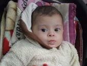 الرضيعة أمينة قشطة تصارع الموت في غزة بين متلازمة داون وعيب قلبي خطير