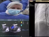 إجراء بث حى لقسطرتين قلبيتين تداخليتين لعيوب القلب الخلقية للأطفال بجامعة طنطا
