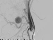 مستشفيات سوهاج الجامعية تنقذ حياة طفلة وتغلق تمددا شريانيا نازفا دون جراحة